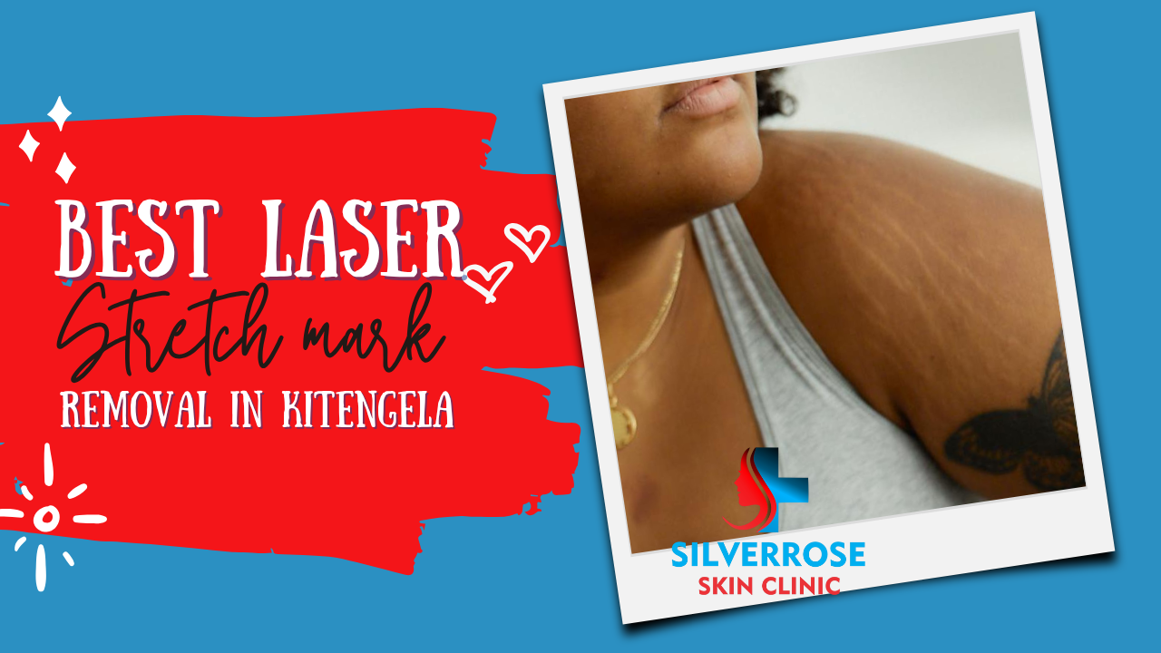 Best Laser Stretch Marks removal in Kitengela