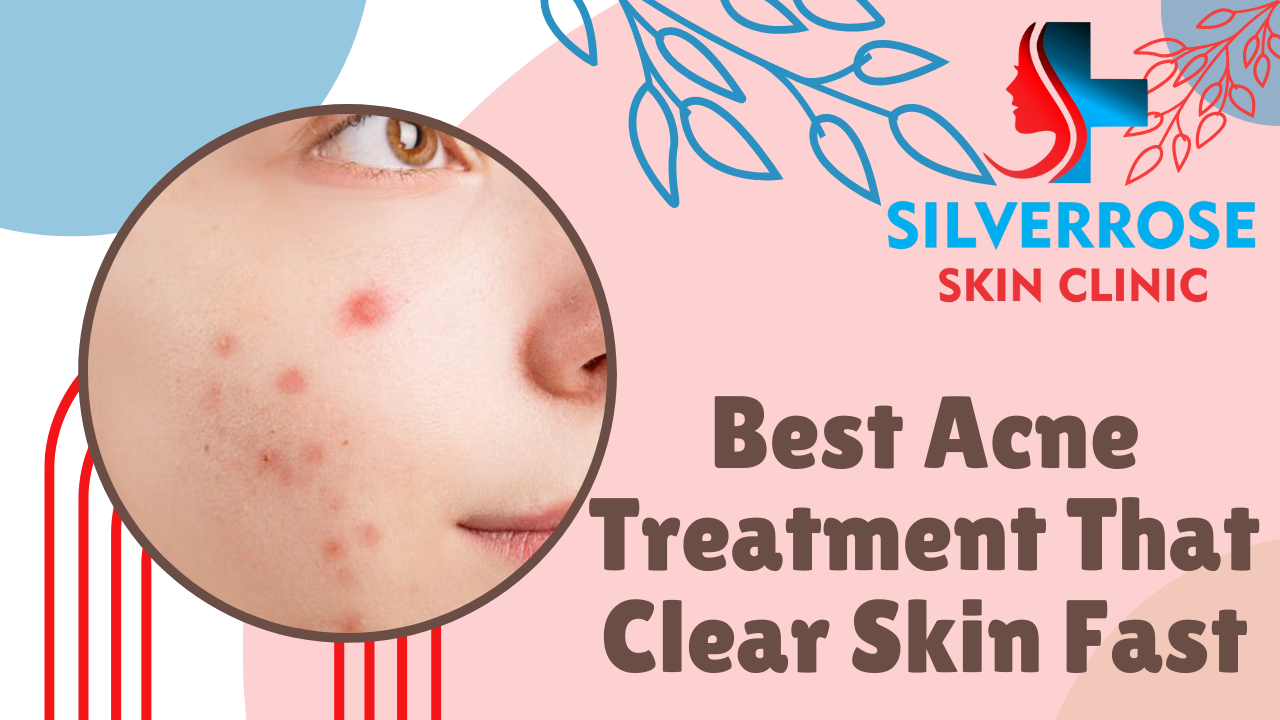Best Acne Treatment