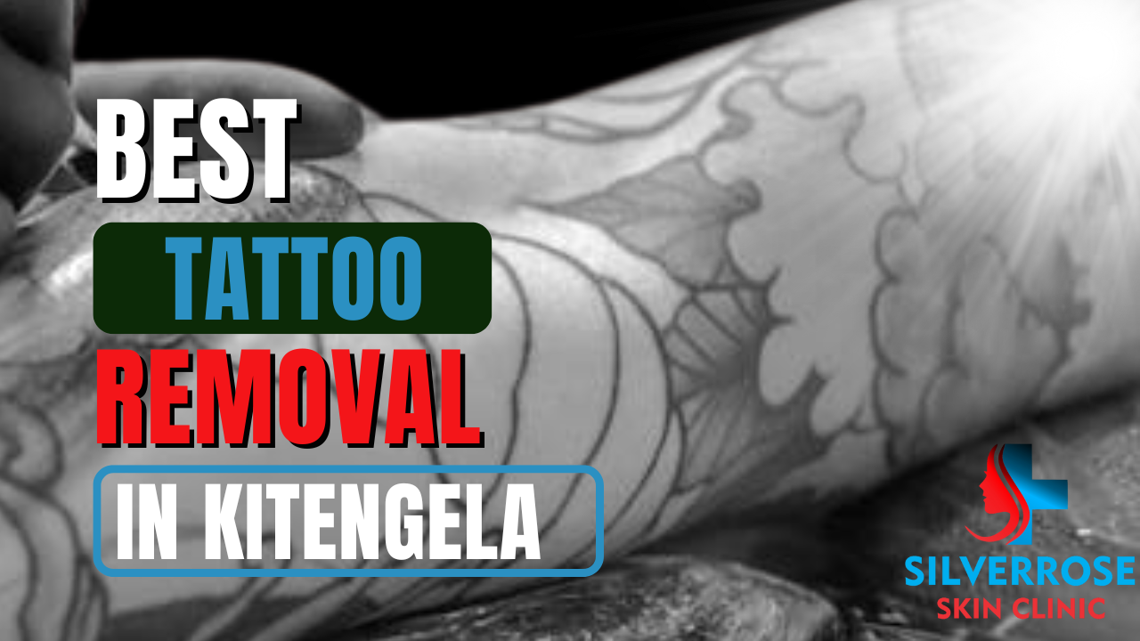 Best Tattoo Removal in Kitengela