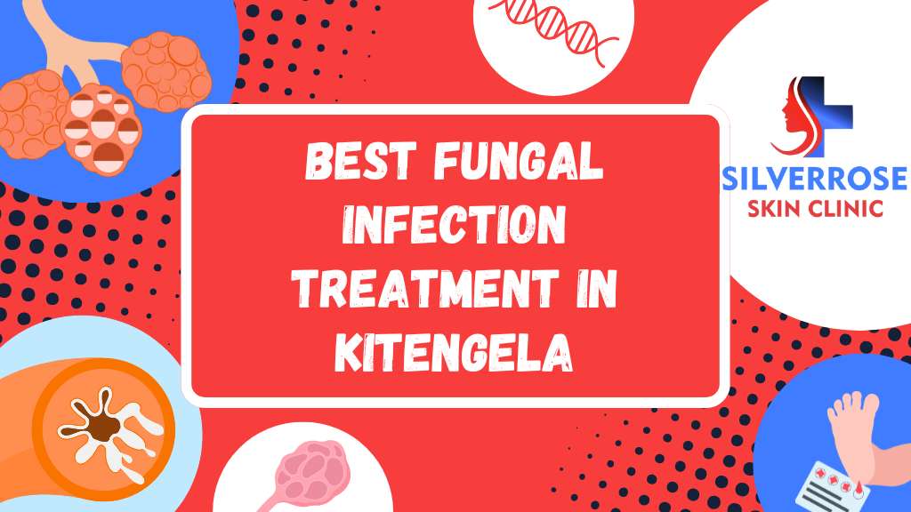 Best Fungal Infection Treatment in Kitengela