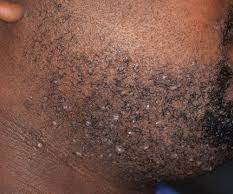 Razor Bumps