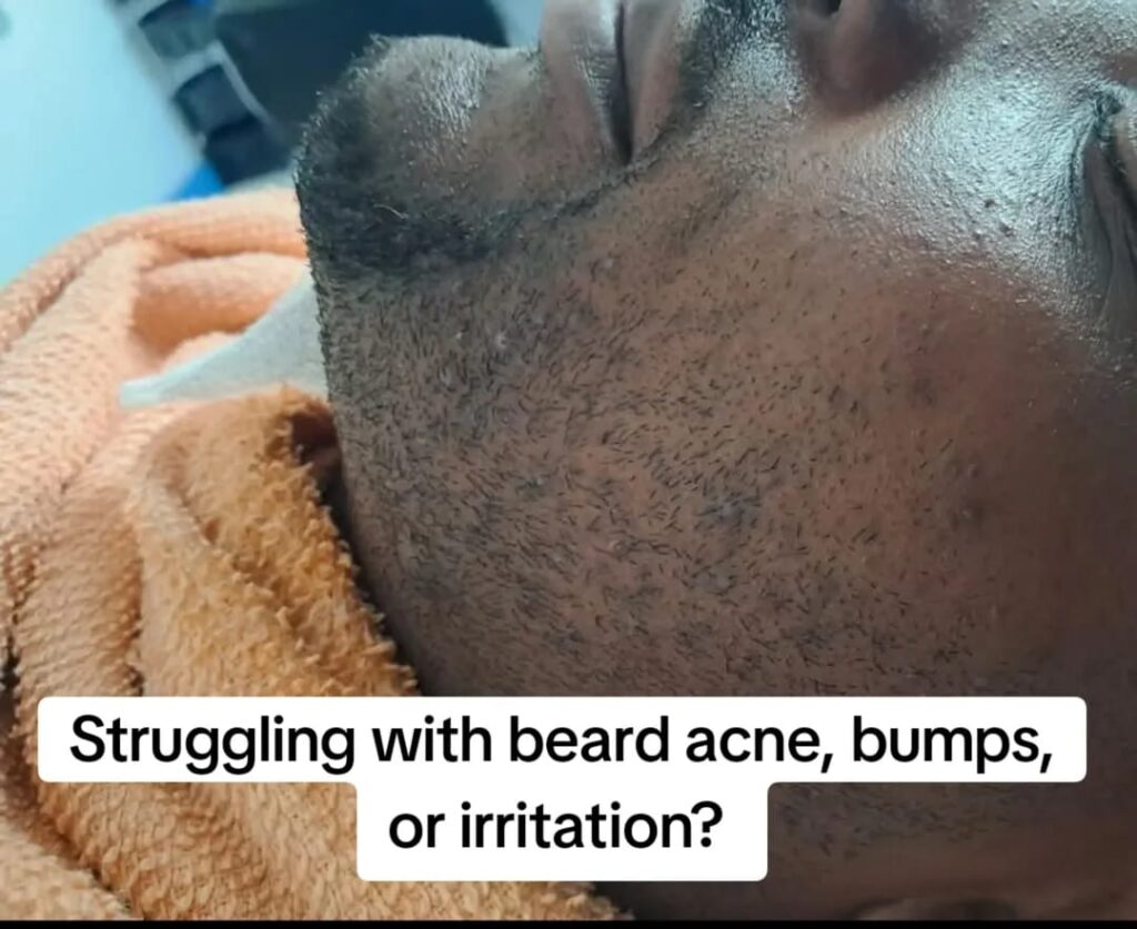 Shaving Bumps Treatment