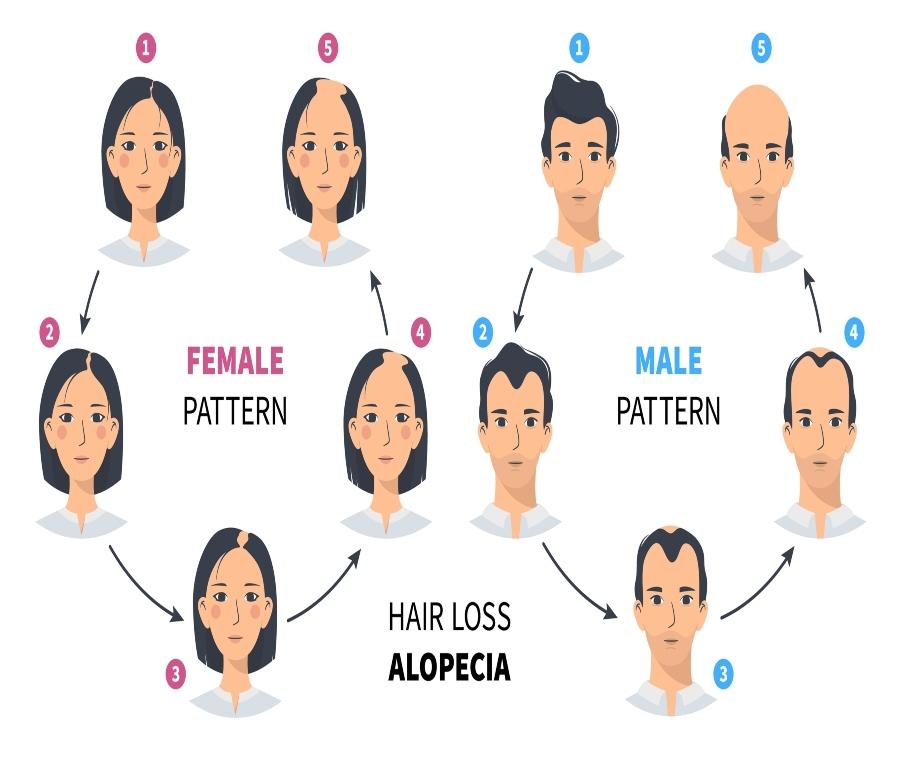 Hairloss in women
