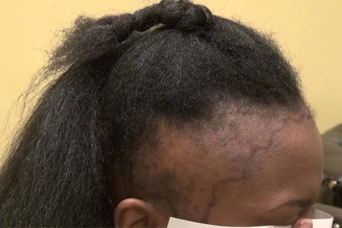 Traction alopecia treatment Kitengela