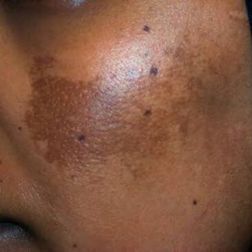 Melasma