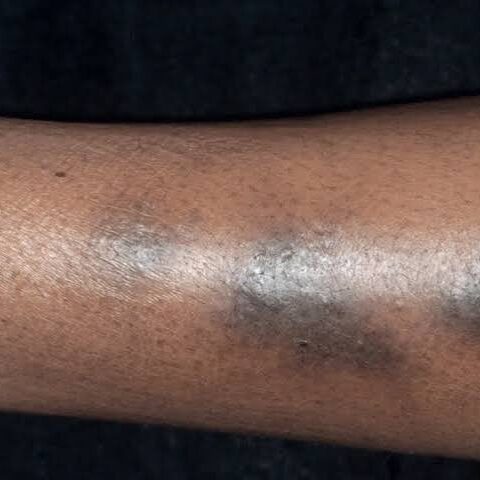Post-inflammatory hyperpigmentation