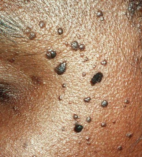Seborrheic-Keratoses