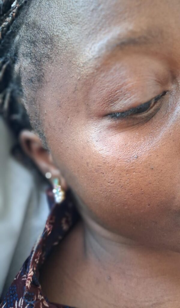 After Skin Tag removal