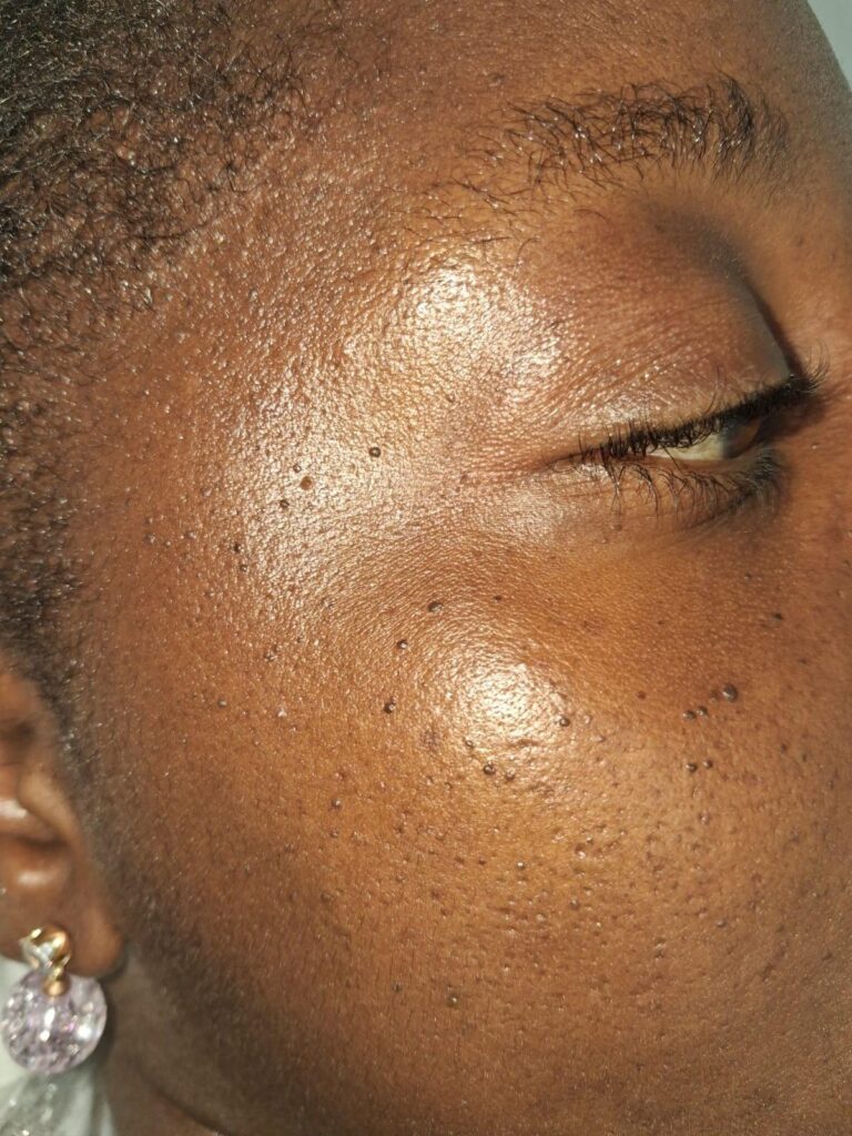 Before skin tag removal