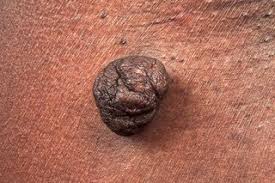 Skin Tags