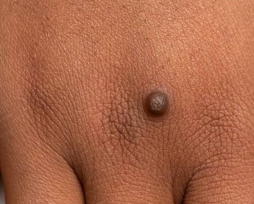 Warts on Black skin